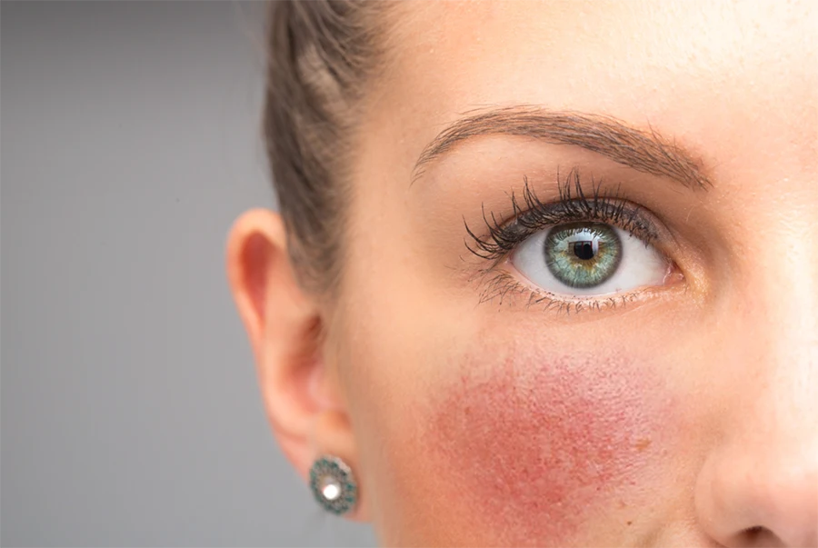 Limpieza facial adaptada para rosácea
